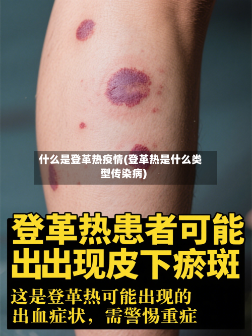 什么是登革热疫情(登革热是什么类型传染病)-第2张图片